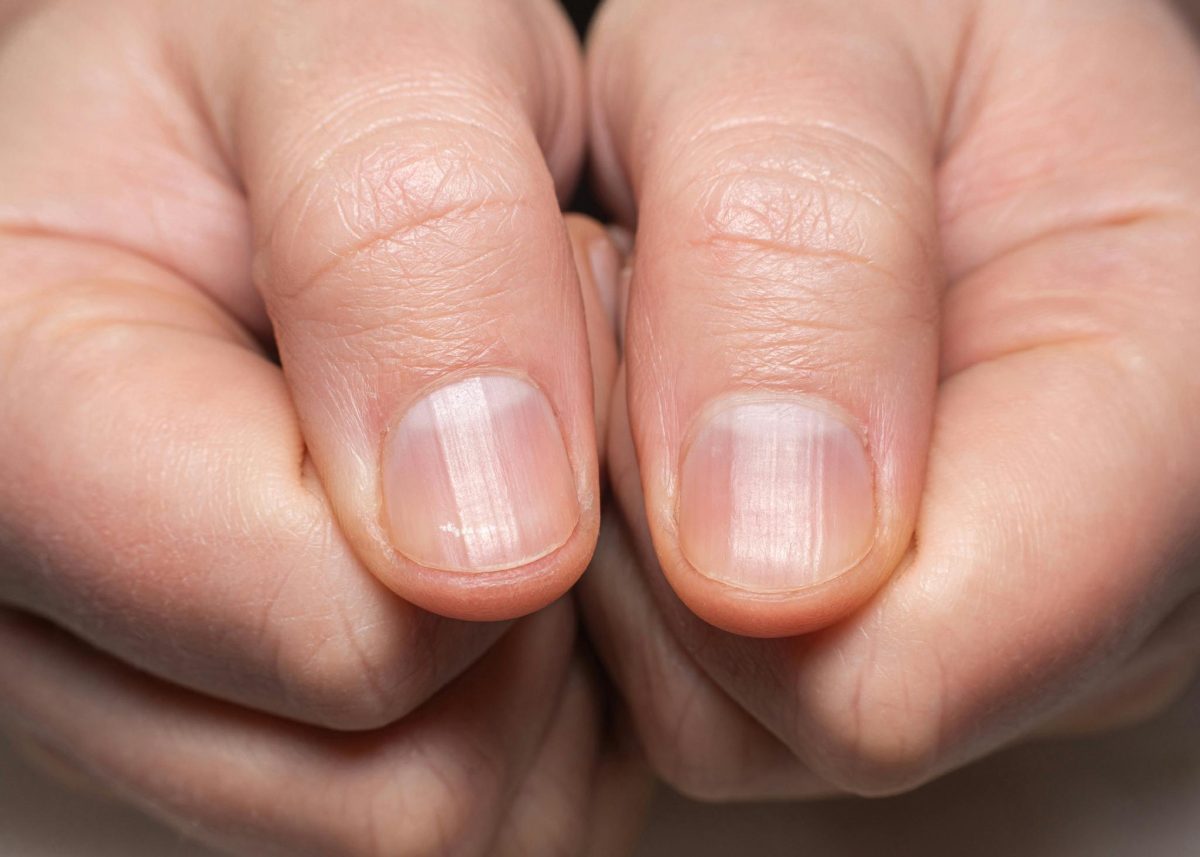 découvrez les causes des ongles striés et leur permanence. apprenez à identifier les différents types de stries et les solutions pour améliorer la santé de vos ongles. un guide complet pour comprendre et prendre soin de vos ongles striés.